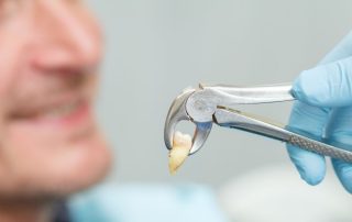 tooth extraction