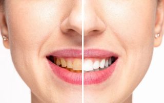 teeth whitening in Annandale, VA