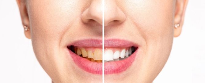 teeth whitening in Annandale, VA