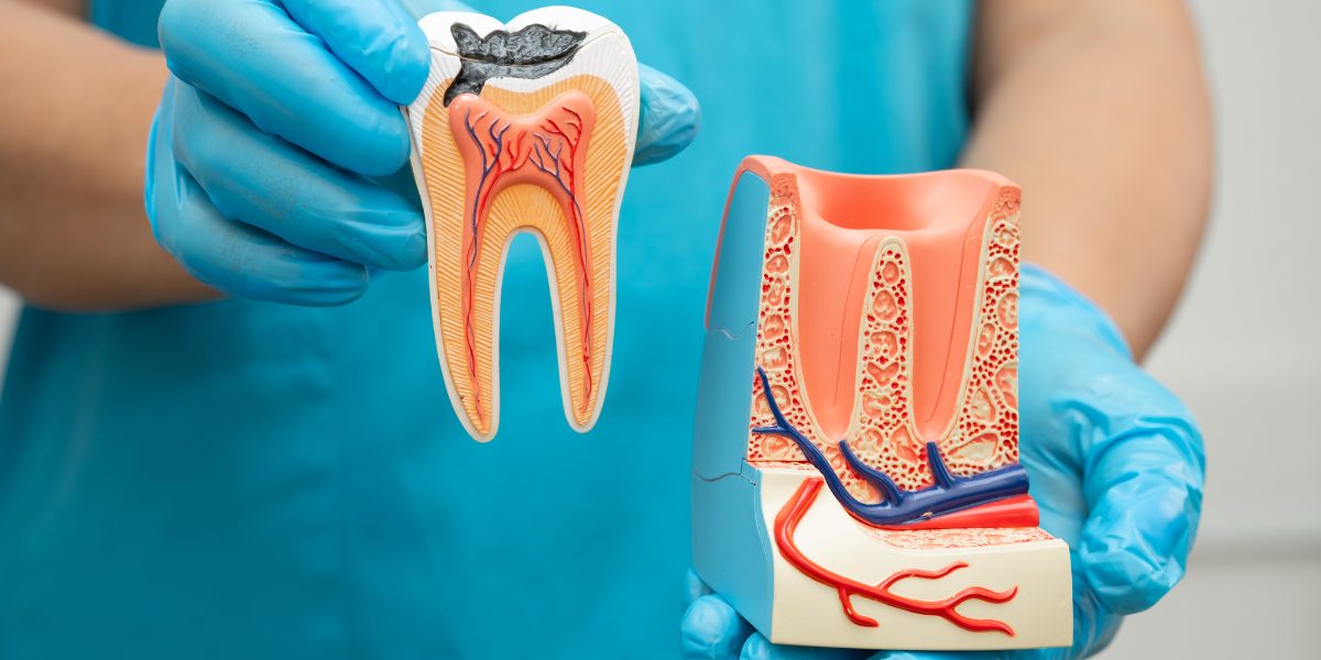root canal